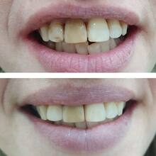 Лечение кариеса взрослому человеку, реставрация зубов, фото до и после