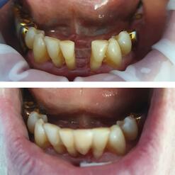 Шинирование и реставрация зубов в рамках терапевтического лечения, фото до и после