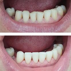 Восстановление зубного ряда с помощью композитных материалов, фото до и после