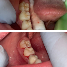 Лечение и реставрация молочных жевательных зубов, фото до и после