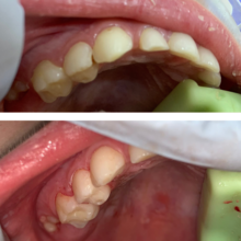 Лечение жевательных зубов ребёнку 6 лет, фото до и после