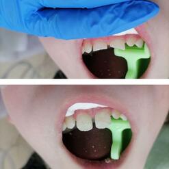 Эстетическая реставрация постоянных зубов ребёнку с фото до и после