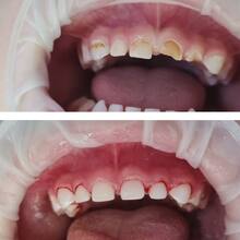 Эндодонтическое лечение молочных зубов под седацией, фото до и после