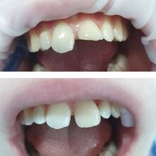 Терапевтическое лечение и реставрация постоянных зубов ребёнку, фото до и после