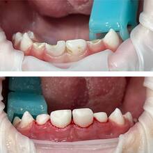 Эндодонтическое лечение и эстетическая реставрация молочных зубов, фото до и после