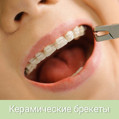 Что такое керамические брекеты и их отличия