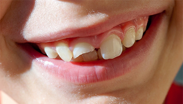 Перелом зуба: диагностика и лечение