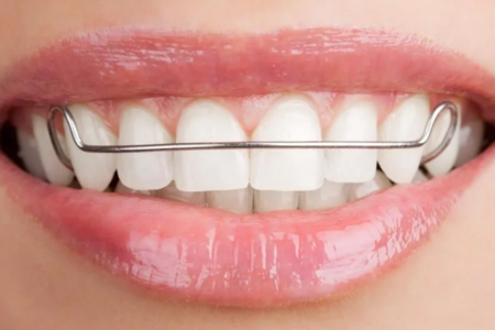 Пластинки для выравнивания зубов: особенности, преимущества и недостатки
