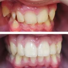 Хирургическое и ортодонтическое лечение ребёнку 13 лет, фото до и после