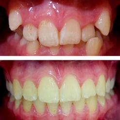 Ортодонтическое лечение ребёнку 14 лет, фото до и после