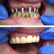 Восстановление зубного ряда, культевые вкладки