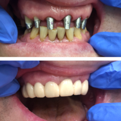 Восстановление зубного ряда, культевые вкладки