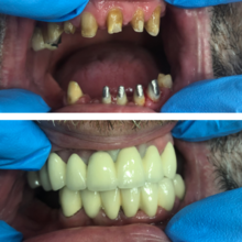 Восстановление зубного ряда, протезы на аттачменах