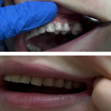 Установка циркониевой коронки, фото до и после
