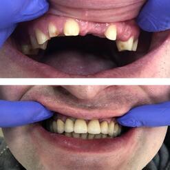 Имплантация с помощью металлокерамических коронок, фото до и после