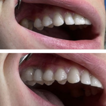 Установка циркониевой коронки на имплантат, фото до и после