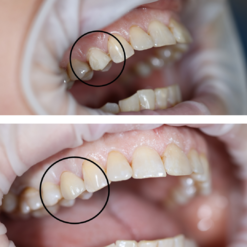 Установка винира на 1 зуб