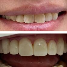 Установка виниров с фото до и после установки