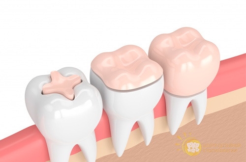 Зубные вкладки