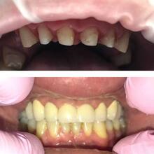 Восстановление зубного ряда с фотографиями до и после