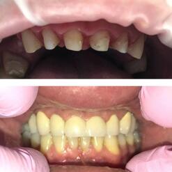 Восстановление зубного ряда с фотографиями до и после