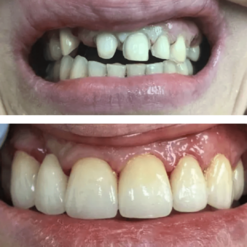 Установка металлокерамического протеза с опорой на зубы