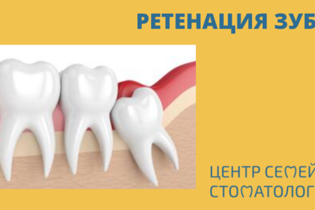 Ретенция зубов: причины патологии и как бороться с такой проблемой