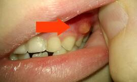Почему на зубе опустилась десна, что делать – стоматология ПрезиДЕНТ