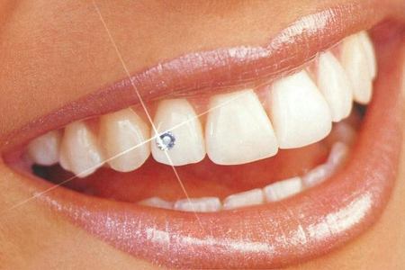 Украшения для зубов: разновидности, особенности, противопоказания