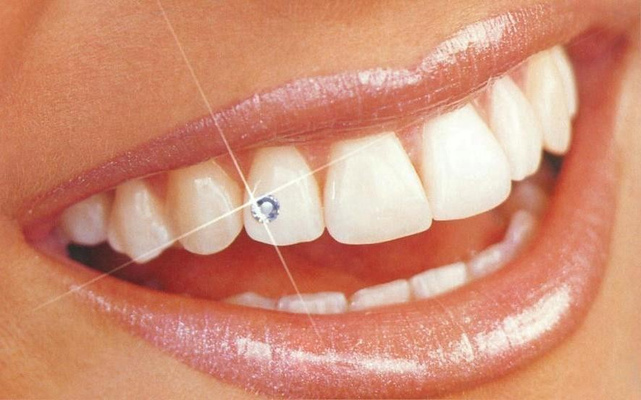 Украшения для зубов: разновидности, особенности, противопоказания