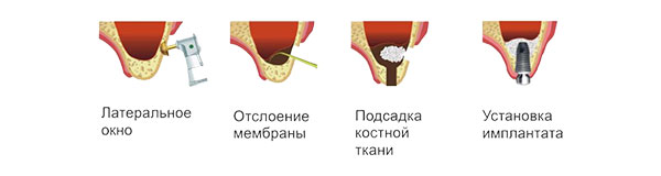 этапы открытого синус-лифтинга