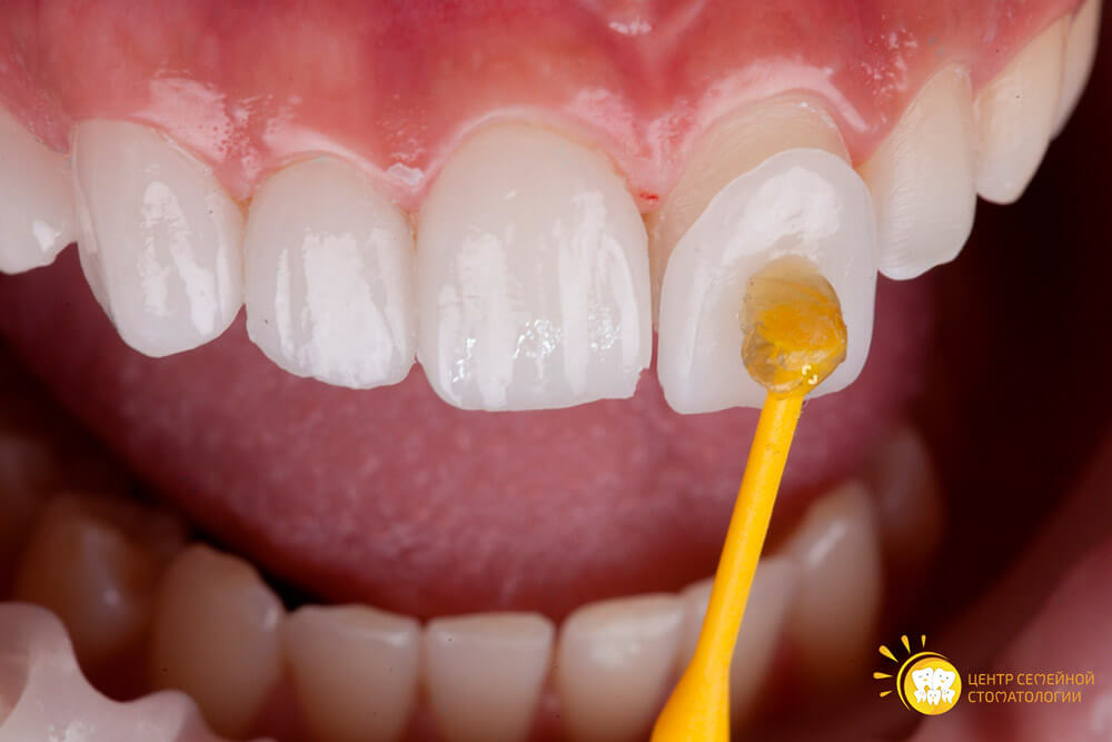 как выглядят керамические виниры