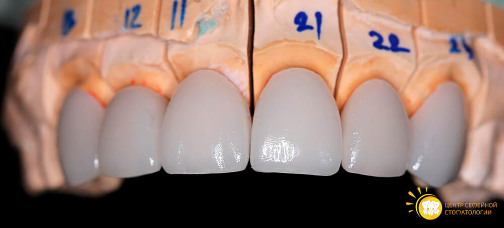 как устанавливают керамические виниры